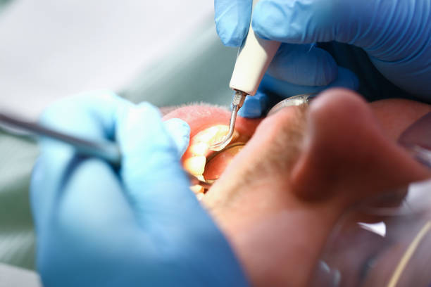 Best Broken or Cracked Tooth Emergency Dentist in Lake Wildwood, CA