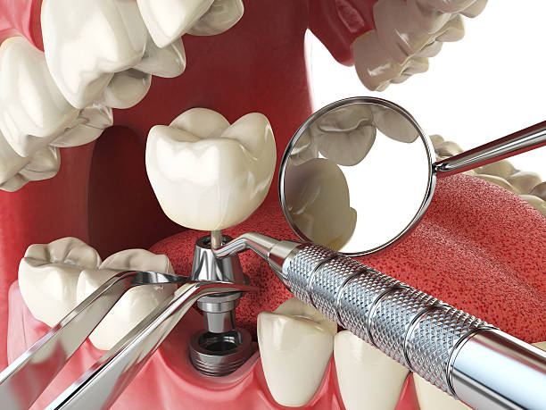 Best Emergency Dental Care for Abscessed Tooth in Lake Wildwood, CA